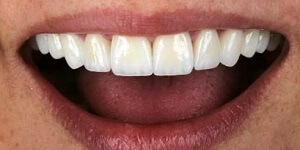 Обточка зубов под виниры 'после' в клинике Super Smile кейс 1