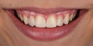 Установка виниров на нижние зубы 'после' в клинике Super Smile кейс 2