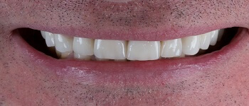 Протезирование передних зубов 'после' в клинике Super Smile кейс 3