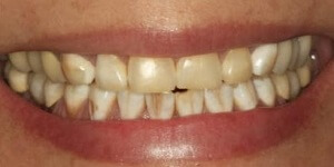 Установка виниров на передние зубы 'до' в клинике Super Smile кейс 1