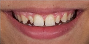 Установка виниров на нижние зубы 'до' в клинике Super Smile кейс 2