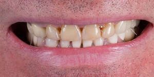 Установка силиконовых зубных протезов 'до' в клинике Super Smile кейс 3