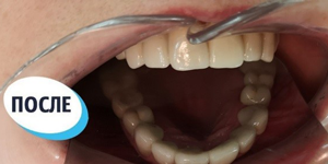 Лечение зубов 'до' в клинике Super Smile кейс 1