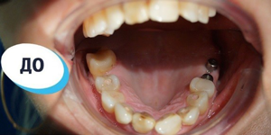 Лечение зубов 'после' в клинике Super Smile кейс 1