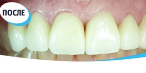 Лечение зубов 'до' в клинике Super Smile кейс 2
