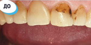 Лечение зубов 'после' в клинике Super Smile кейс 2