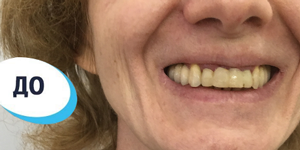 Лечение зубов 'после' в клинике Super Smile кейс 3
