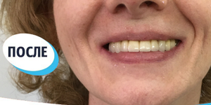 Лечение зубов 'до' в клинике Super Smile кейс 3