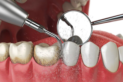 Удаление зубного камня при профессиональной чистке зубов