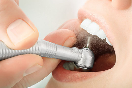 Чистка аппаратом Air Flow при профессиональной чистке зубов