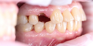 Мостовидное протезирование зубов 'до' в клинике Super Smile кейс 1