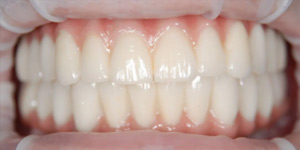 Установка условно-съёмных зубных протезов 'после' в клинике Super Smile кейс 3