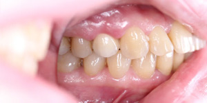 Мостовидное протезирование зубов 'после' в клинике Super Smile кейс 1