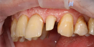 Несъёмное протезирование зубов 'до' в клинике Super Smile кейс 3