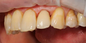 Несъёмное протезирование зубов 'после' в клинике Super Smile кейс 3