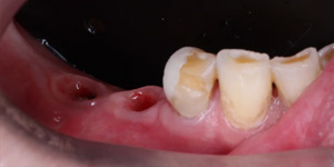 Протезирование зубов нижней челюсти 'до' в клинике Super Smile кейс 1