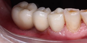 Протезирование зубов нижней челюсти 'дпосле в клинике Super Smile кейс 1