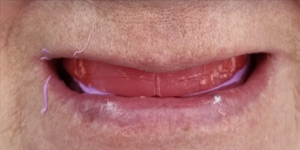 Протезирование зубов нижней челюсти 'до' в клинике Super Smile кейс 2