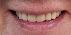 Протезирование зубов нижней челюсти 'после' в клинике Super Smile кейс 2
