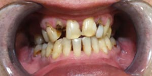 Протезирование передних зубов 'до' в клинике Super Smile кейс 1
