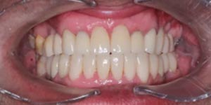 Протезирование передних зубов 'после' в клинике Super Smile кейс 1