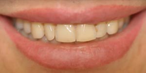 Протезирование передних зубов 'до' в клинике Super Smile кейс 2