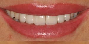 Протезирование передних зубов 'после' в клинике Super Smile кейс 2