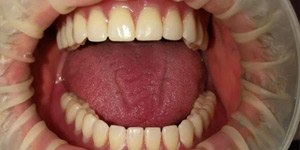 Протезирование зубов в спб 'после' в клинике Super Smile кейс 3
