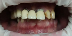 Установка условно-съёмных зубных протезов 'до' в клинике Super Smile кейс 2