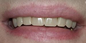 Установка условно-съёмных зубных протезов 'после' в клинике Super Smile кейс 2