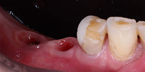 Протезирование частичной потери зубов 'до' в клинике Super Smile кейс 3