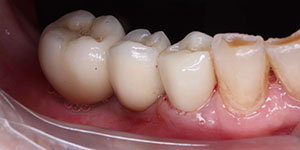 Протезирование частичной потери зубов 'после' в клинике Super Smile кейс 3