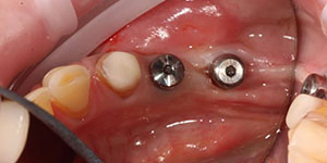 Протезирование частичной потери зубов 'до' в клинике Super Smile кейс 2