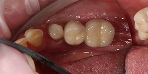 Протезирование частичной потери зубов 'после' в клинике Super Smile кейс 2