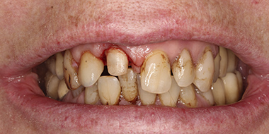 Протезирование зубов в спб 'до' в клинике Super Smile кейс 2