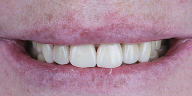 Протезирование зубов в спб 'после' в клинике Super Smile кейс 2