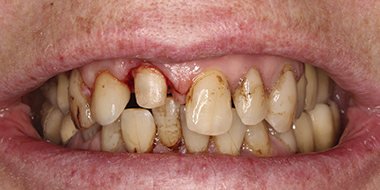 Шинирование зубов 'до' в клинике Super Smile кейс 1