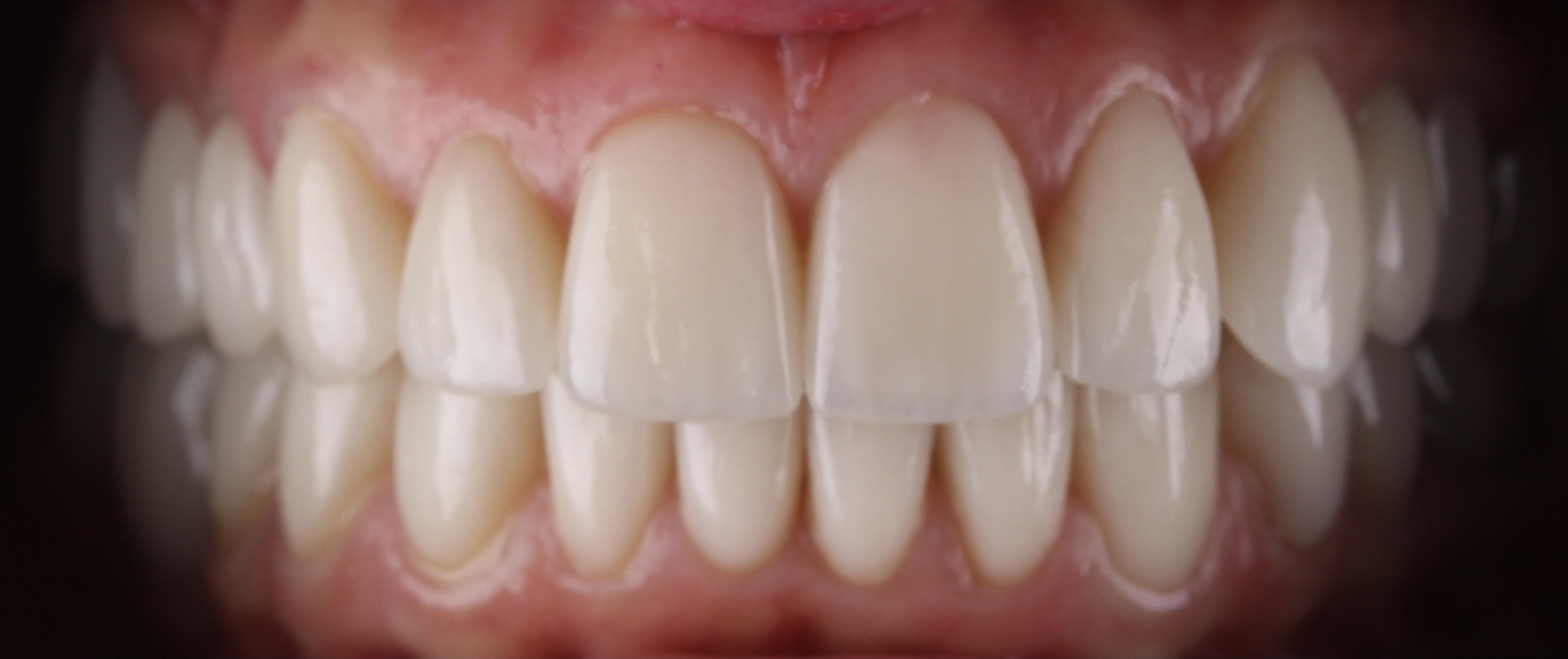 Лечение шейки зуба 'после' в клинике Super Smile кейс 2
