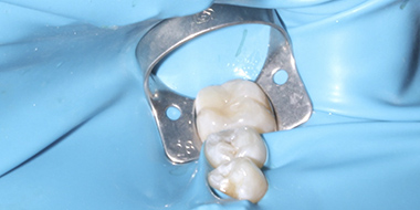 Лечение отека зуба 'после' в клинике Super Smile кейс 3