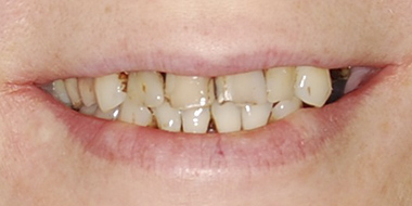 Шинирование зубов 'до' в клинике Super Smile кейс 2