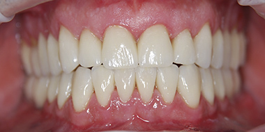 Шинирование зубов 'после' в клинике Super Smile кейс 2