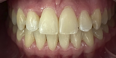 Шинирование зубов 'после' в клинике Super Smile кейс 3