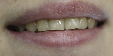 Лечение потемневшего зуба 'до' в клинике Super Smile кейс 1