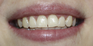 Лечение потемневшего зуба 'после' в клинике Super Smile кейс 1