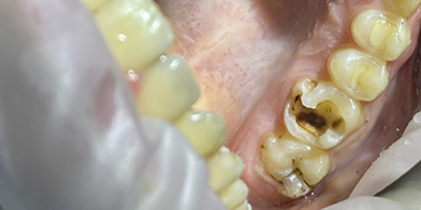Лечение потемневшего зуба 'до' в клинике Super Smile кейс 2