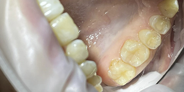 Лечение потемневшего зуба 'после' в клинике Super Smile кейс 2