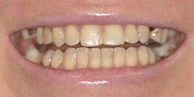 Лечение потемневшего зуба 'до' в клинике Super Smile кейс 3
