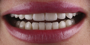 Лечение потемневшего зуба 'после' в клинике Super Smile кейс 3