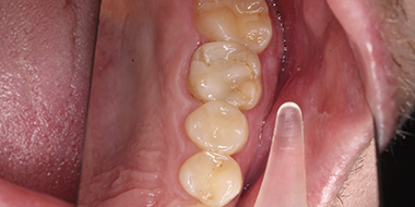 Лечение ткани зуба 'до' в клинике Super Smile кейс 3