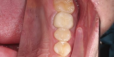 Лечение ткани зуба 'после' в клинике Super Smile кейс 3